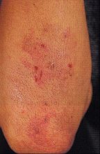 Dermatite erpetiforme di Duhring