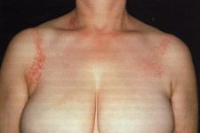 Dermatite allergica da contatto (DAC)