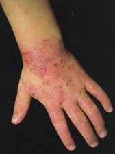 Dermatite atopica (DA)