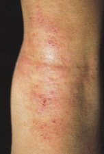 Dermatite atopica (DA)
