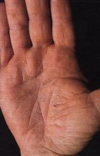 Dermatite irritativa da contatto (DIC)